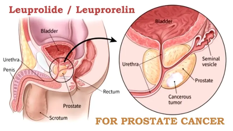 Is Lupron Depot effective in the treatment of Prostate Cancer